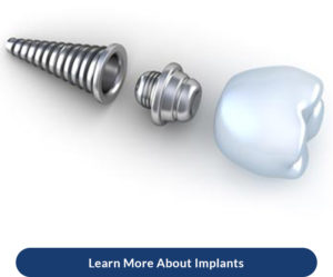 dental implant specialist in moorpark ca