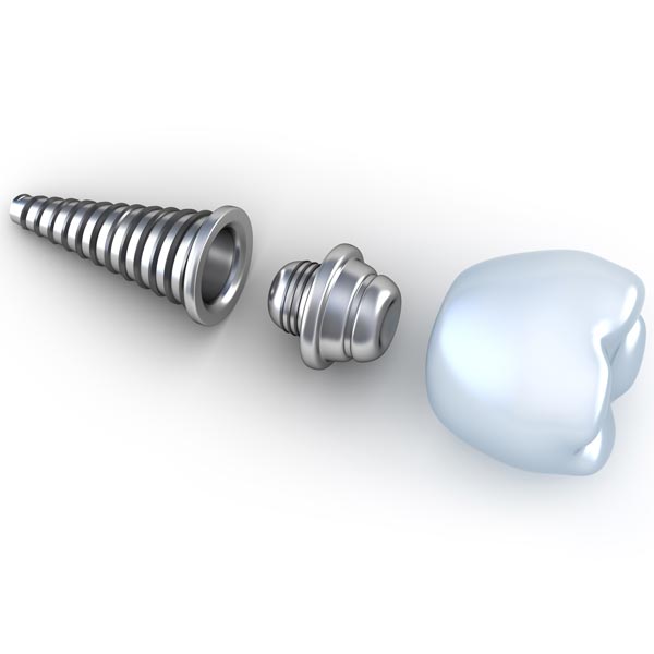 moorpark ca implants