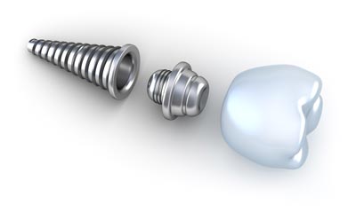 dental implants in moorpark ca
