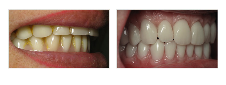 before & after of smile makeover
