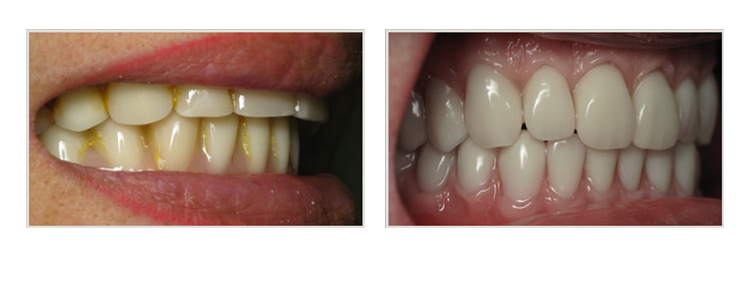 before & after of smile makeover