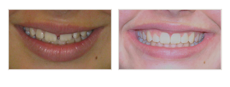 before & after of smile makeover