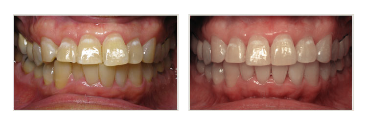 before & after of smile makeover