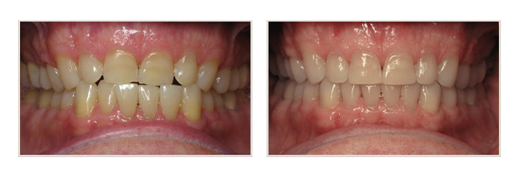 before & after of smile makeover