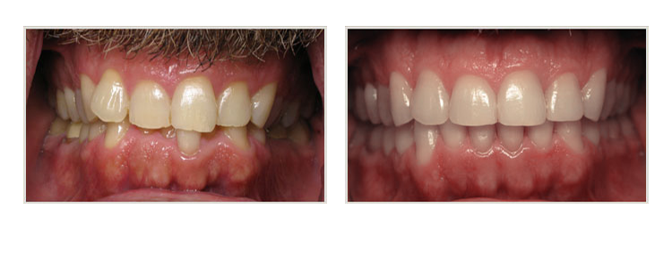 before & after of smile makeover