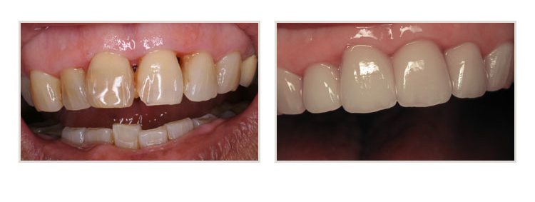 before & after of smile makeover