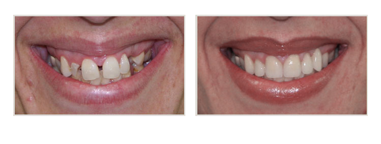 before & after of smile makeover