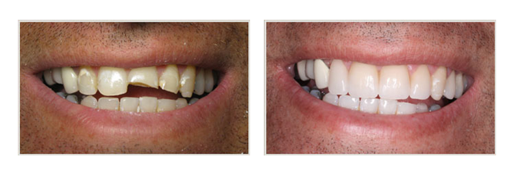 before & after of smile makeover