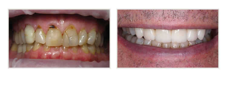 before & after of smile makeover