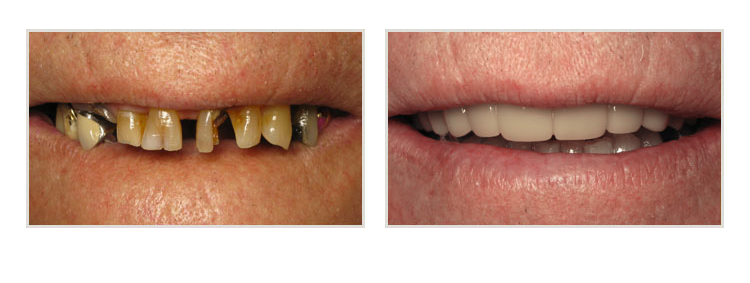 before & after of smile makeover